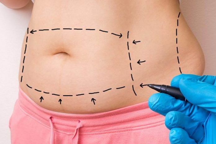 abdominoplastia cirurjià abdominoplastia cirurgià