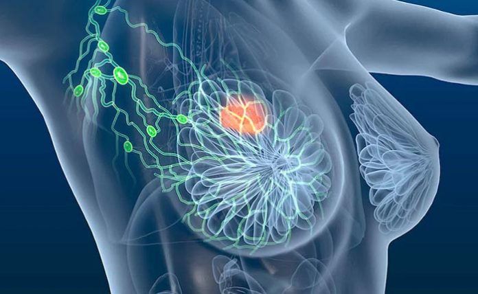 cancer tumor